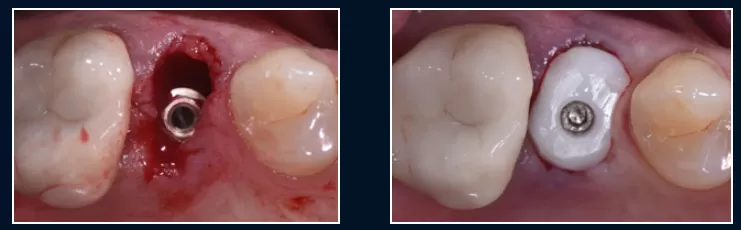 Procedura post estrattiva