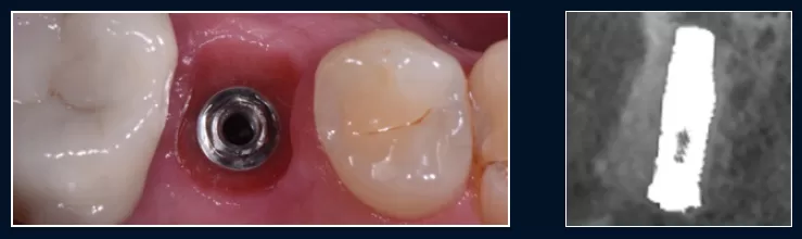 Procedura post estrattiva