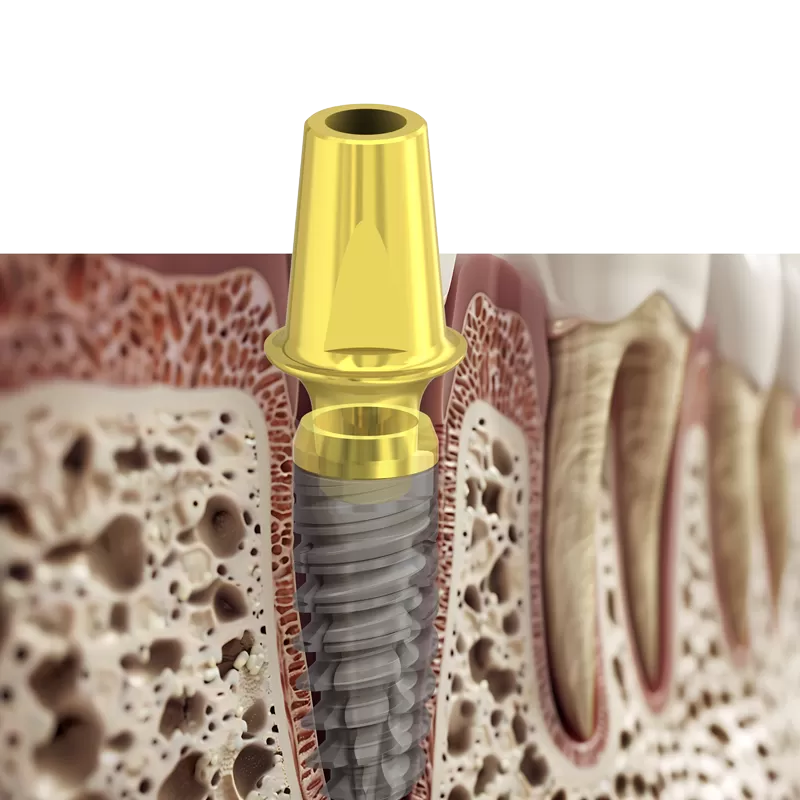 Procedura chirurgica Newton standard