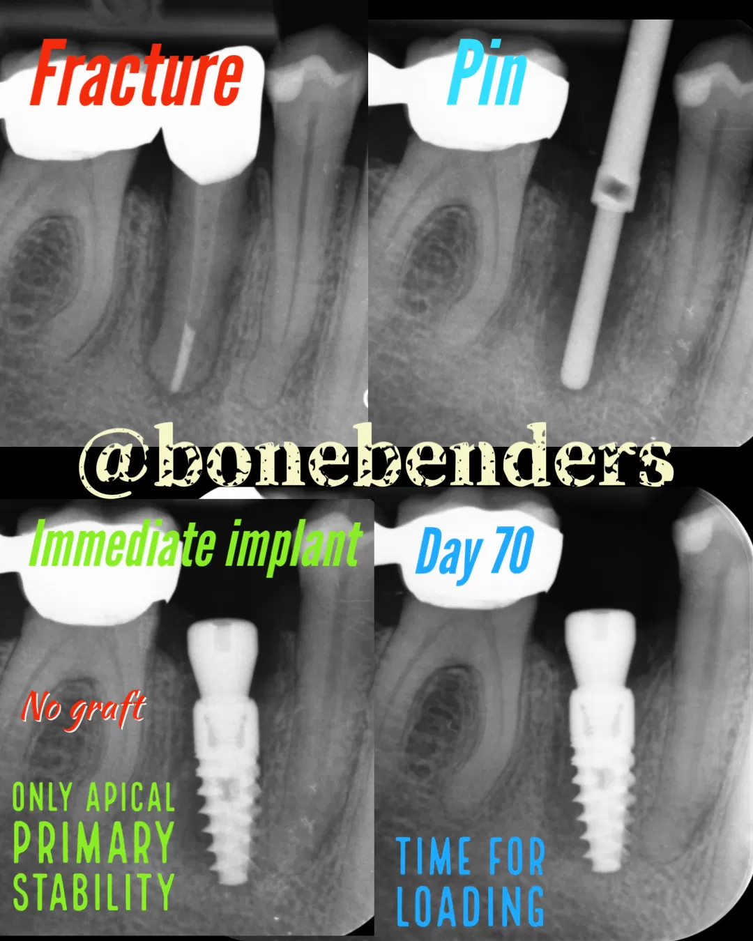 Espansione apicale: un approccio innovativo in implantologia