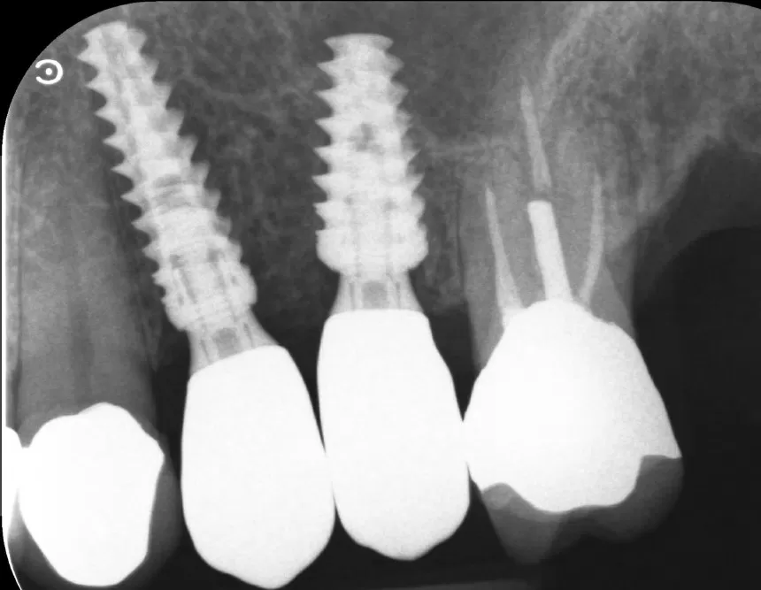 Stabilità di un altro pianeta: minirialzo e carico immediato