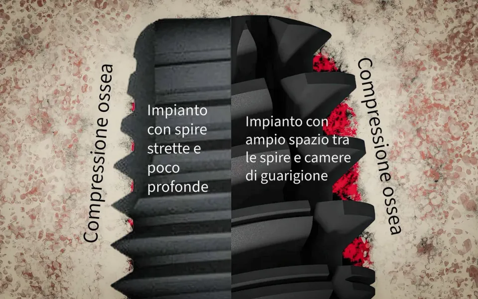 50Ncm e Più: Benefici e Rischi del Torque Alto